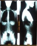 Spinal X-ray analysis used when clinically indicated